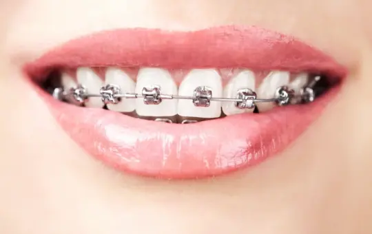 Metal to Aligner