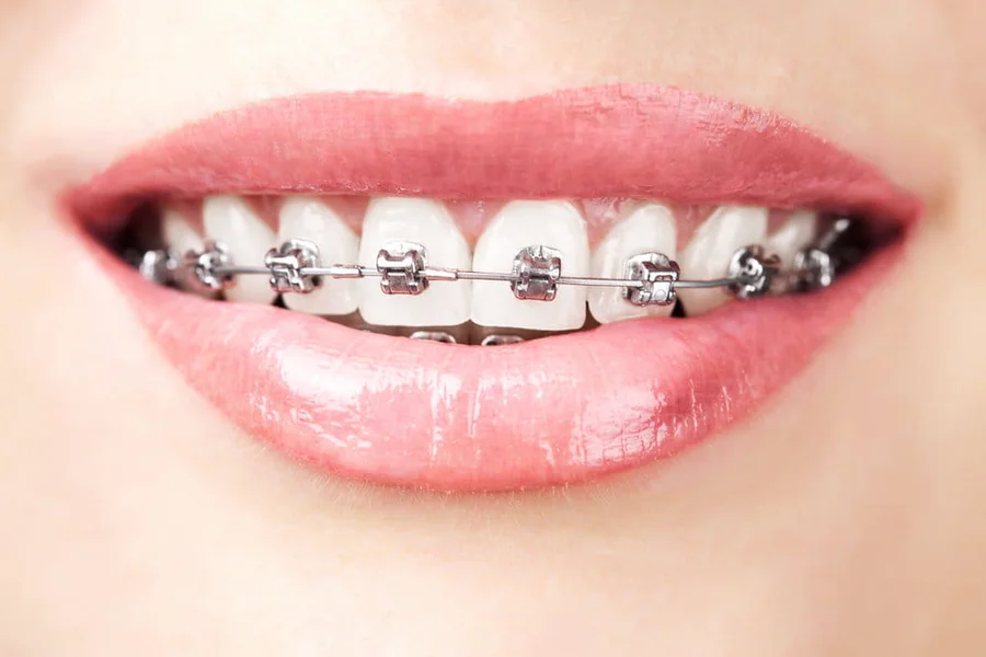 Metal to Aligner